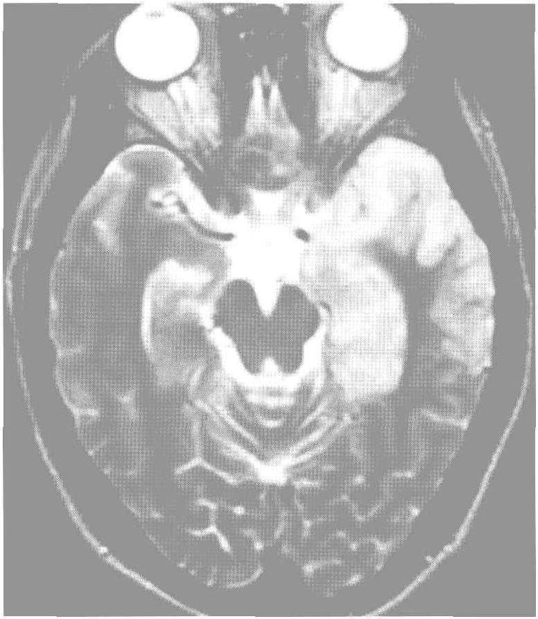 34.單純皰疹性腦炎